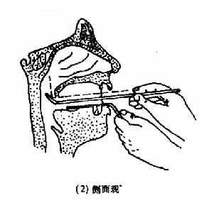 间接鼻咽镜（后鼻镜）检查法