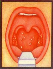 扁桃体及咽部角化症