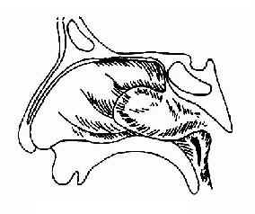 鼻咽血管纤维瘤