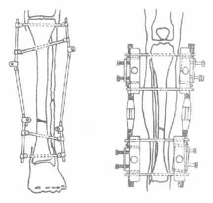 第五节胫腓骨骨干骨折 骨科学 中医世家