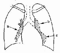 慢性肺原性心病X线胸片正位
