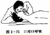 心肺复苏——口对口呼吸