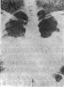 心源性肺水肿的X线表现