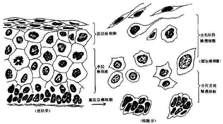 鳞癌组织学与细胞学对照示意图
