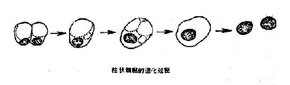 退化变性的柱状细胞与腺癌细胞示意图