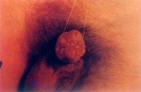 阴茎高分化鳞状细胞癌