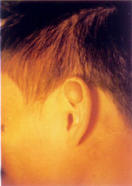 左耳纤维瘤