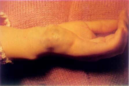 左手腕尺侧蔓状大血管瘤