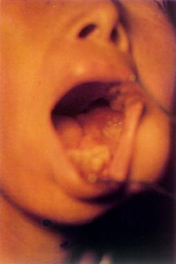 口腔内高分化鳞状细胞癌