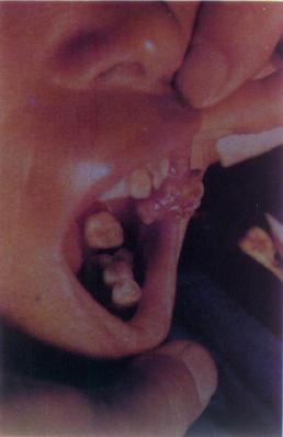口腔内（颊部）乳突状高分化鳞癌
