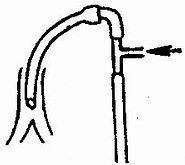 小儿麻醉中常用的T管装置，箭头示氧气与挥发麻醉药进入处，下端为延长管，任其开放
