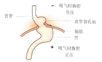 食管裂孔疝对胃食管连接处解剖结构的影响