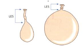 用气球来比拟胃：胃过度扩张致LES变短