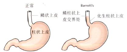 Barrett食管