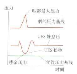 UES松驰时压力曲线呈M型
