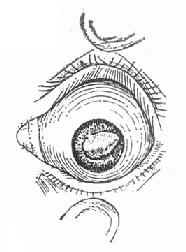 晶体嵌顿瞳孔