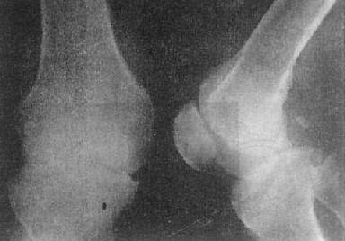 关节破坏——膝关节结核
