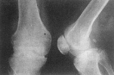关节退行性变－膝关节退行性骨关节病