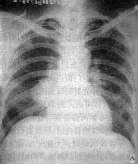 右肺中心型肺癌伴肺门淋巴结转移