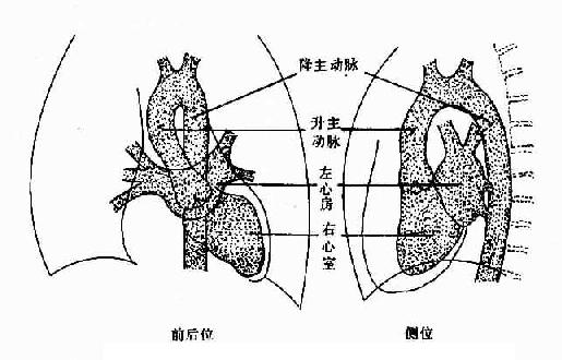 正常左心房、左心室、主动脉造影示意图