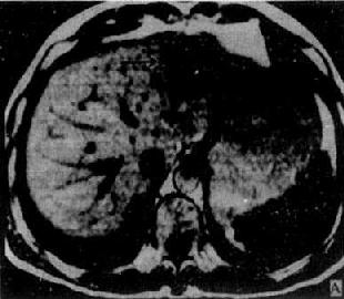 肝血管瘤（MRI）