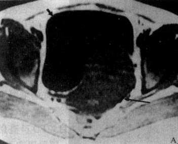 子宫肌瘤MRI