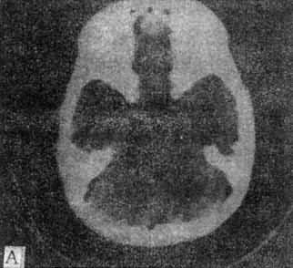 正常头部CT扫描