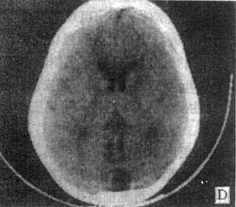 正常头部CT扫描