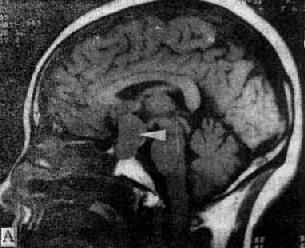 MRI扫描SE序列图像