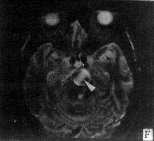 MRI扫描SE序列图像